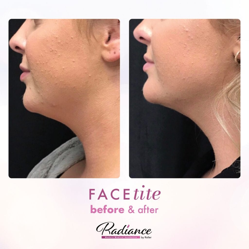 FaceTite Before & After Gallery - Patient 12856 - Image 1