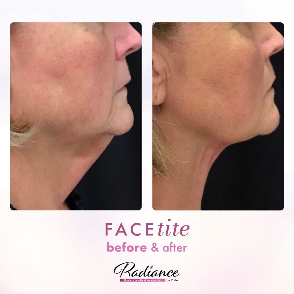 FaceTite Before & After Gallery - Patient 12854 - Image 1