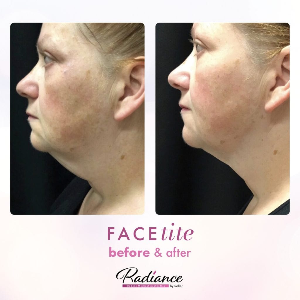 FaceTite Before & After Gallery - Patient 12848 - Image 1