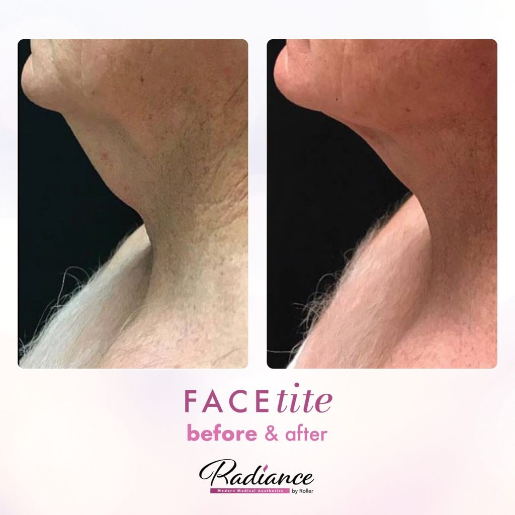 FaceTite Before & After Gallery - Patient 12846 - Image 1