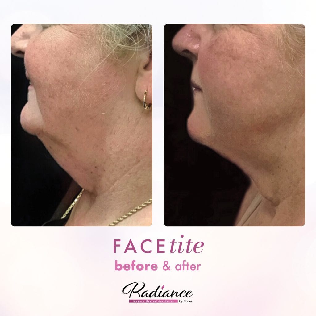 FaceTite Before & After Gallery - Patient 12844 - Image 1