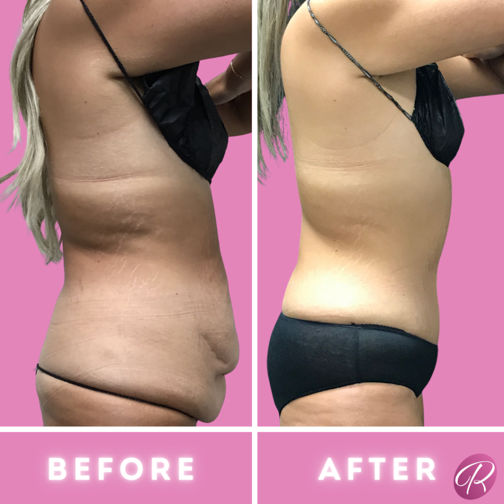 Tummy Tuck and Abdominoplasty Before & After Gallery - Patient 13151 - Image 1