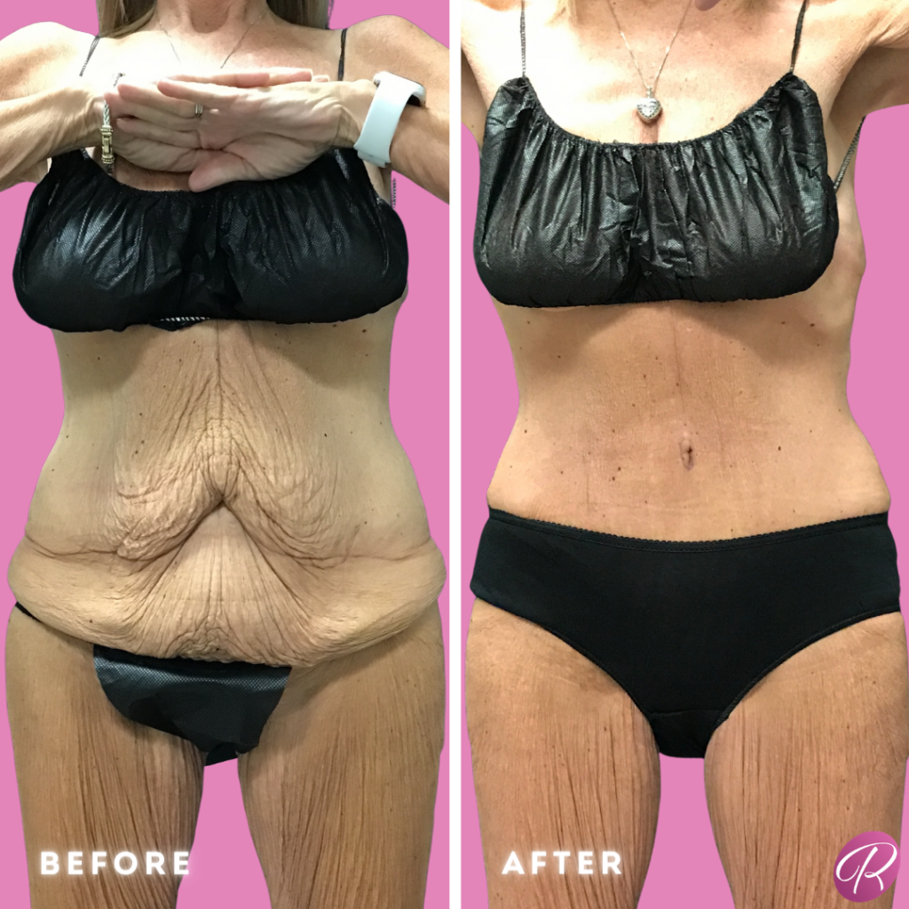Tummy Tuck and Abdominoplasty Before & After Gallery - Patient 13148 - Image 1