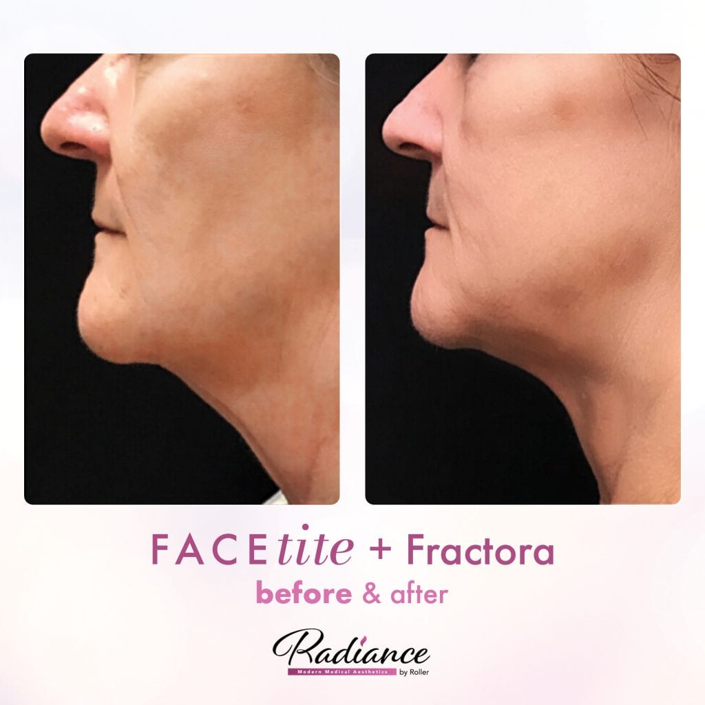 FaceTite Before & After Gallery - Patient 12836 - Image 1