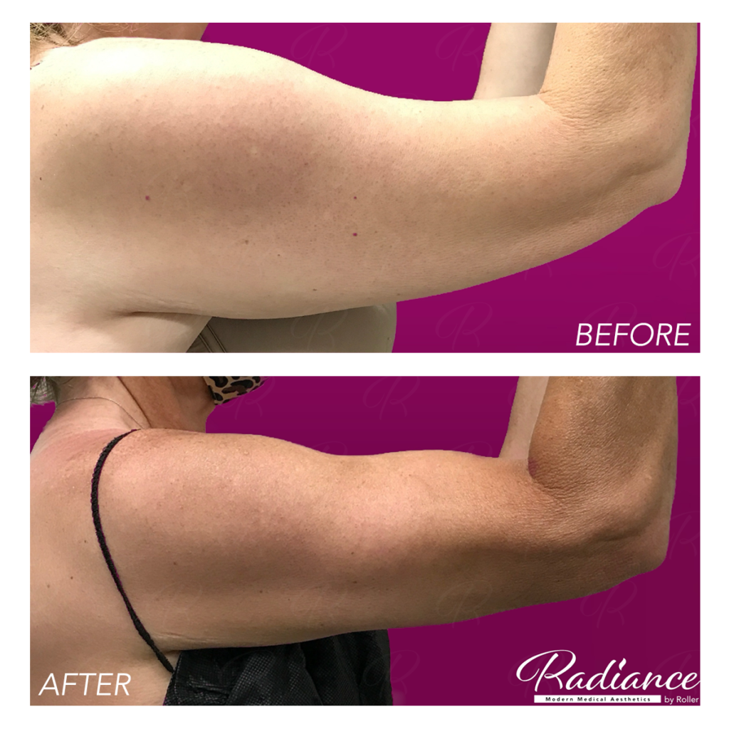 BodyTite Before & After Gallery - Patient 12811 - Image 4