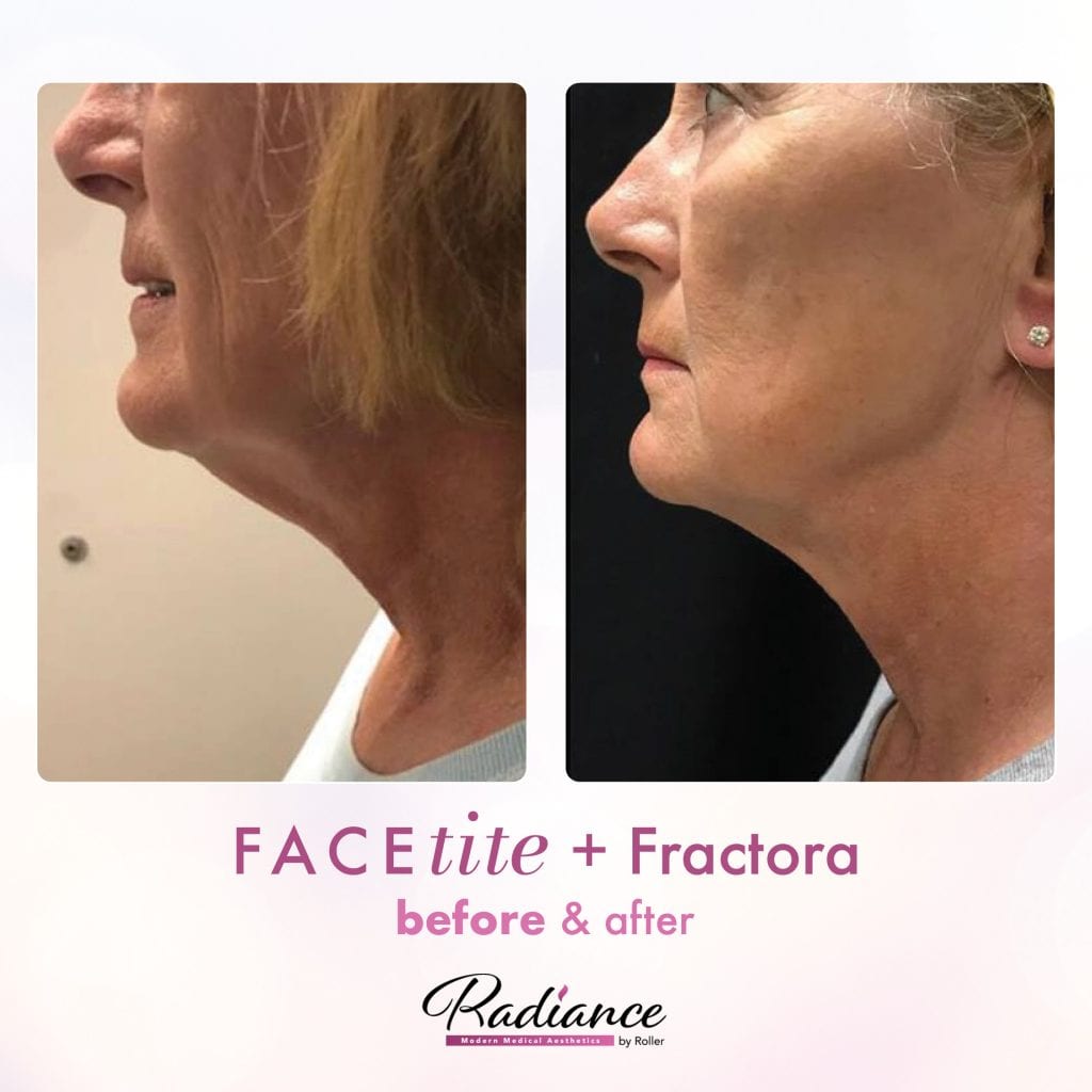 FaceTite Before & After Gallery - Patient 12834 - Image 1