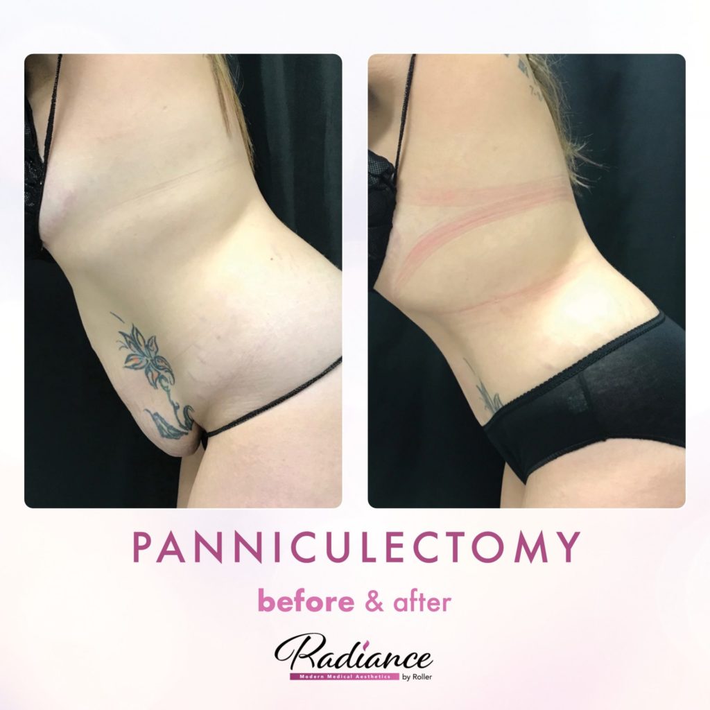 Tummy Tuck and Abdominoplasty Before & After Gallery - Patient 13146 - Image 1