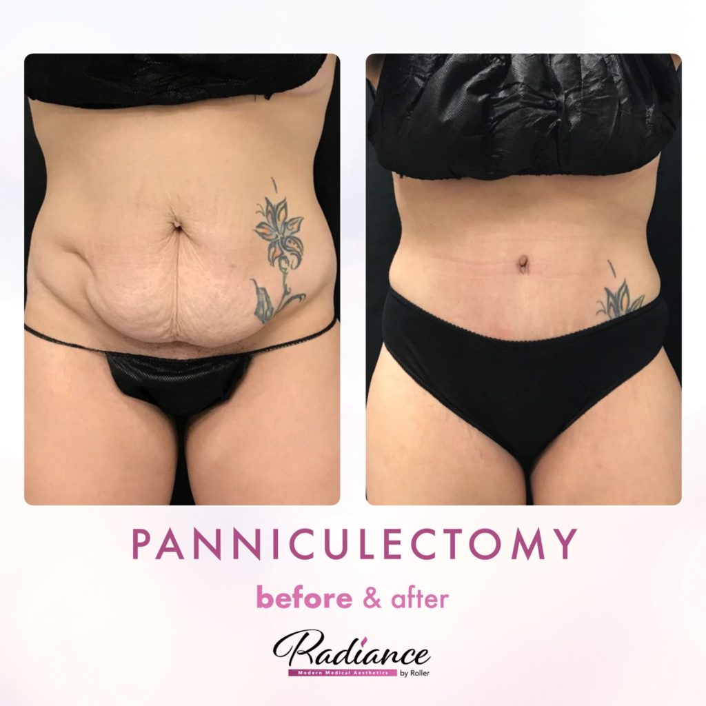 Tummy Tuck and Abdominoplasty Before & After Gallery - Patient 13139 - Image 1