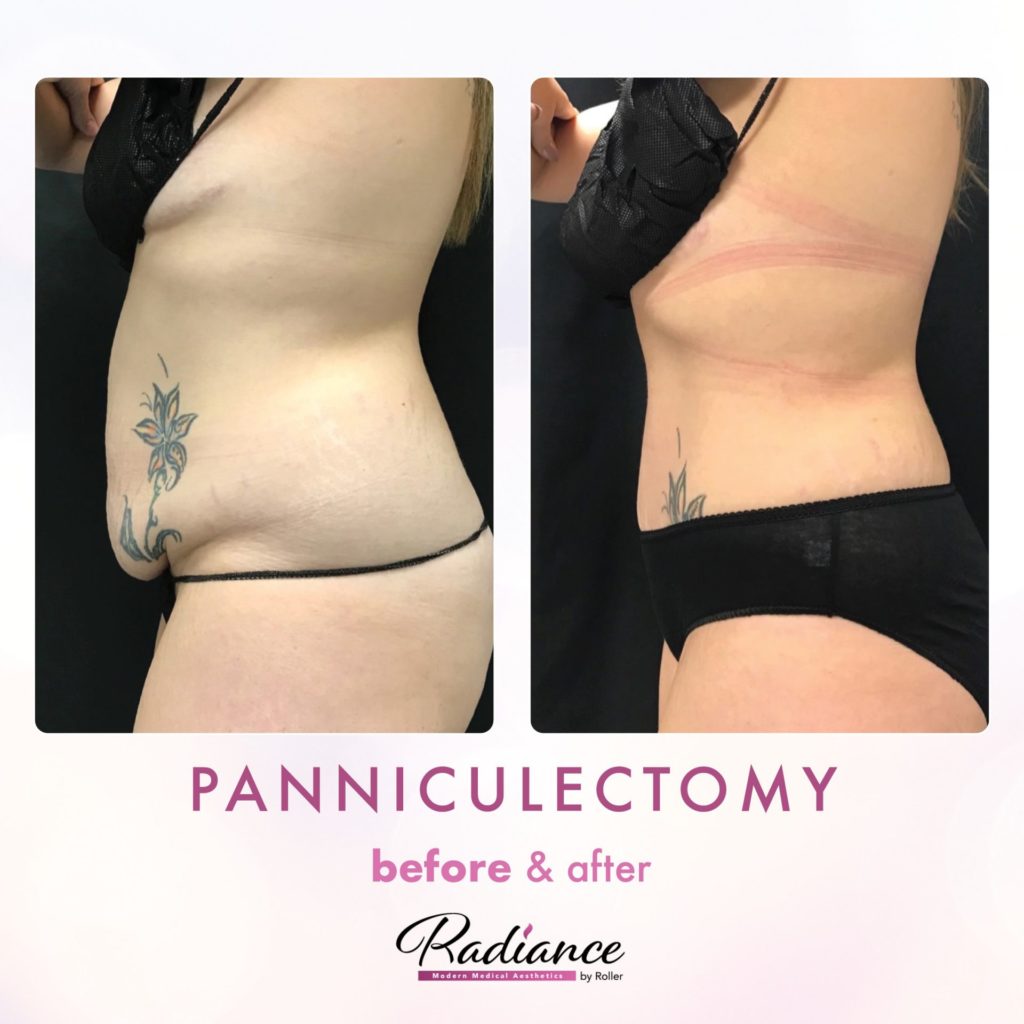 Tummy Tuck and Abdominoplasty Before & After Gallery - Patient 13139 - Image 2