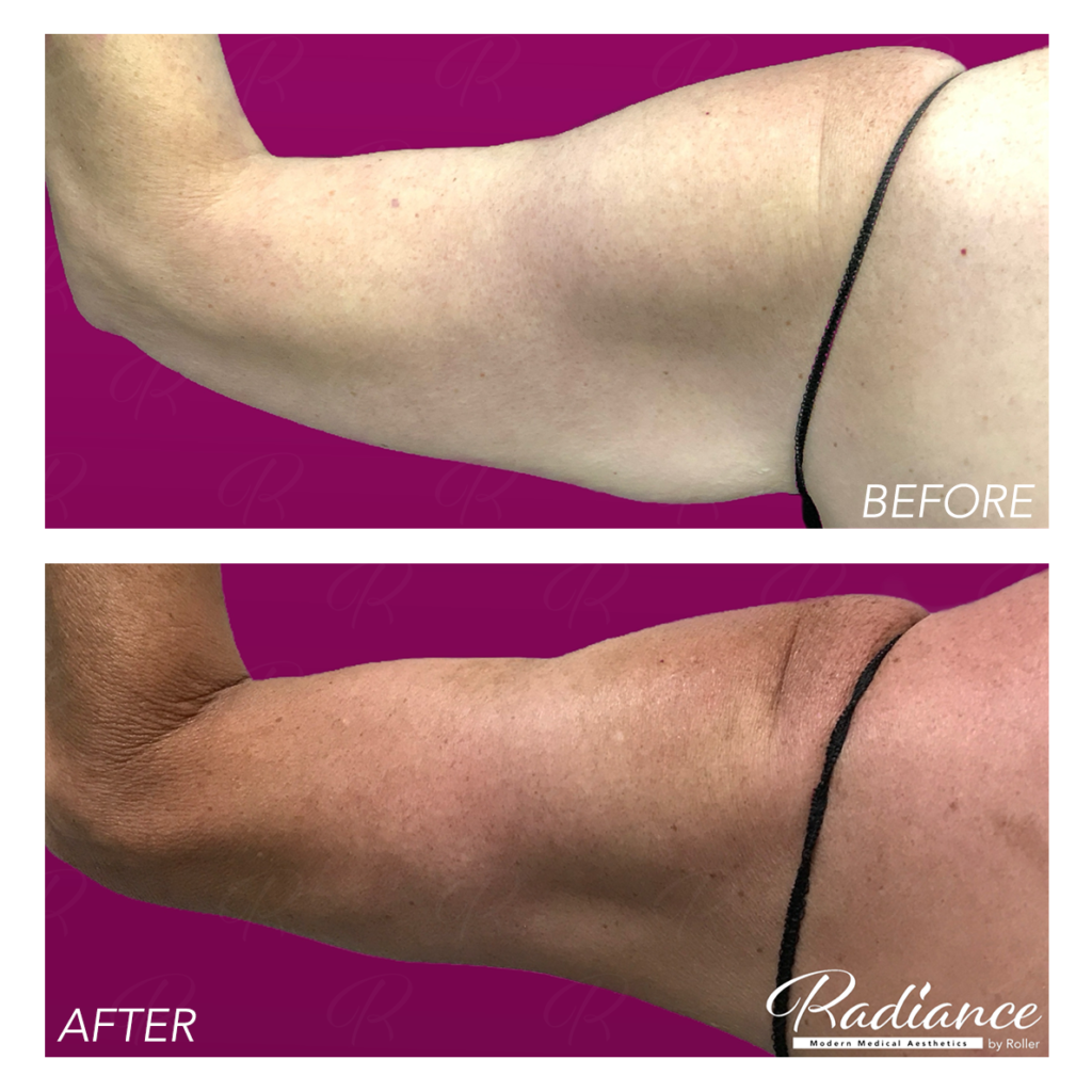 BodyTite Before & After Gallery - Patient 12811 - Image 7