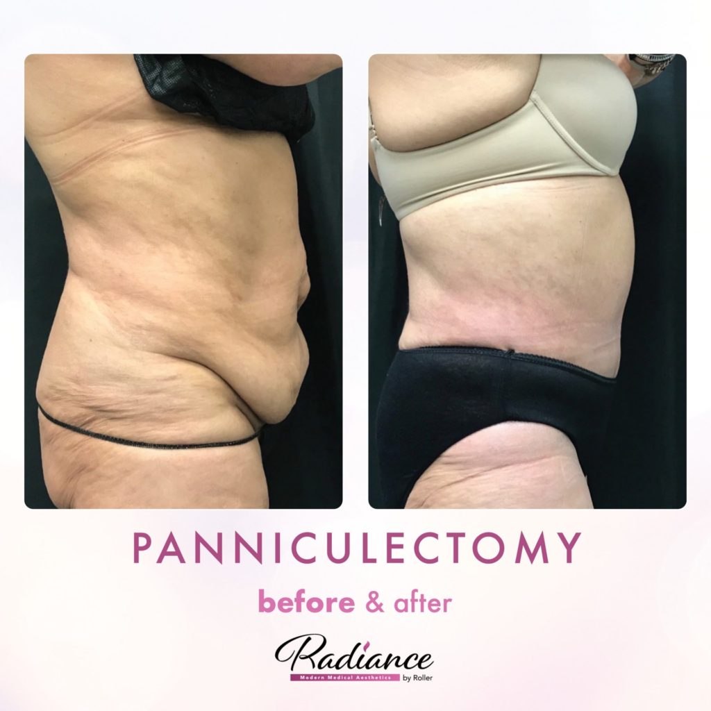Tummy Tuck and Abdominoplasty Before & After Gallery - Patient 13136 - Image 2