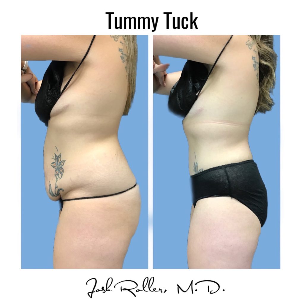 Tummy Tuck and Abdominoplasty Before & After Gallery - Patient 13139 - Image 3