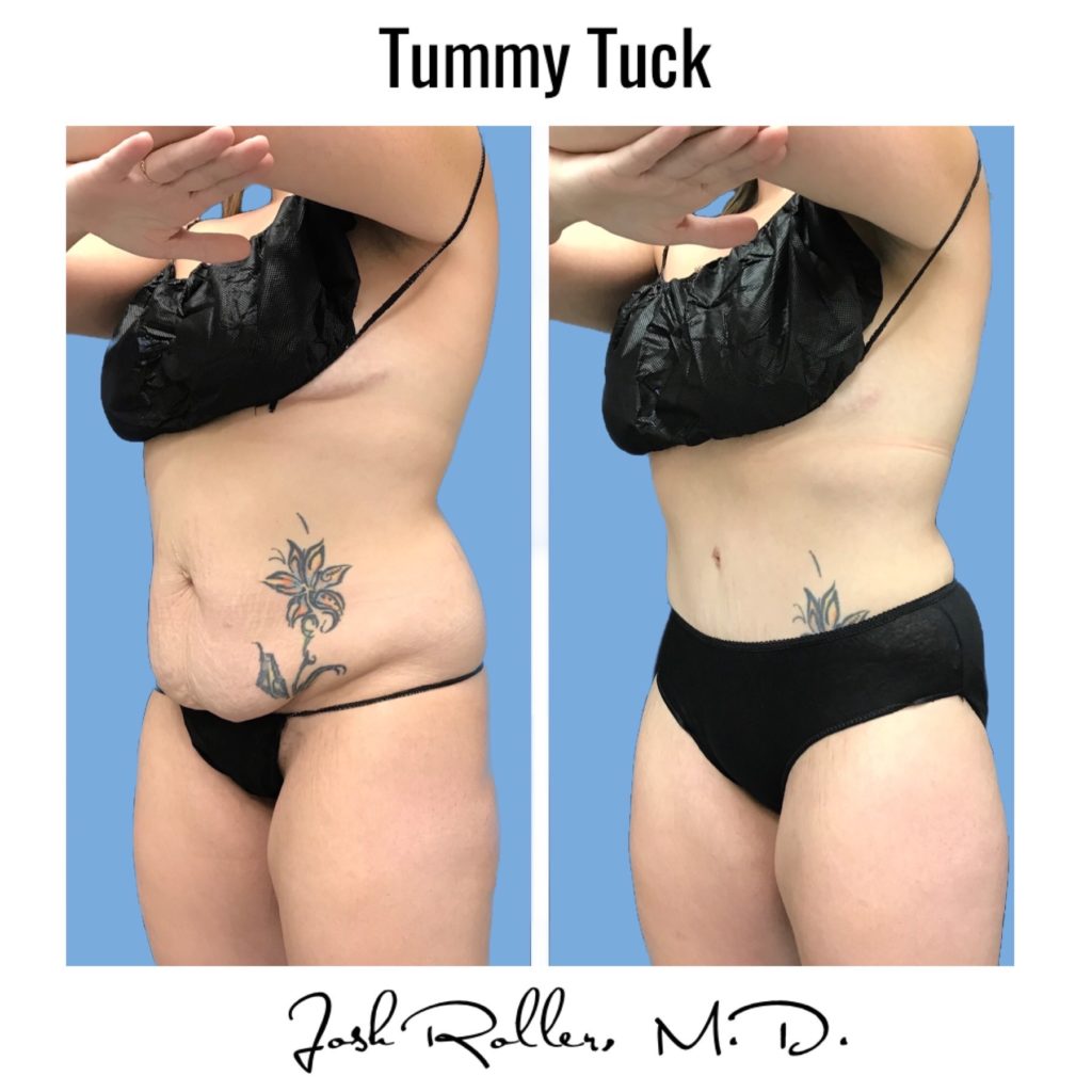 Tummy Tuck and Abdominoplasty Before & After Gallery - Patient 13139 - Image 4