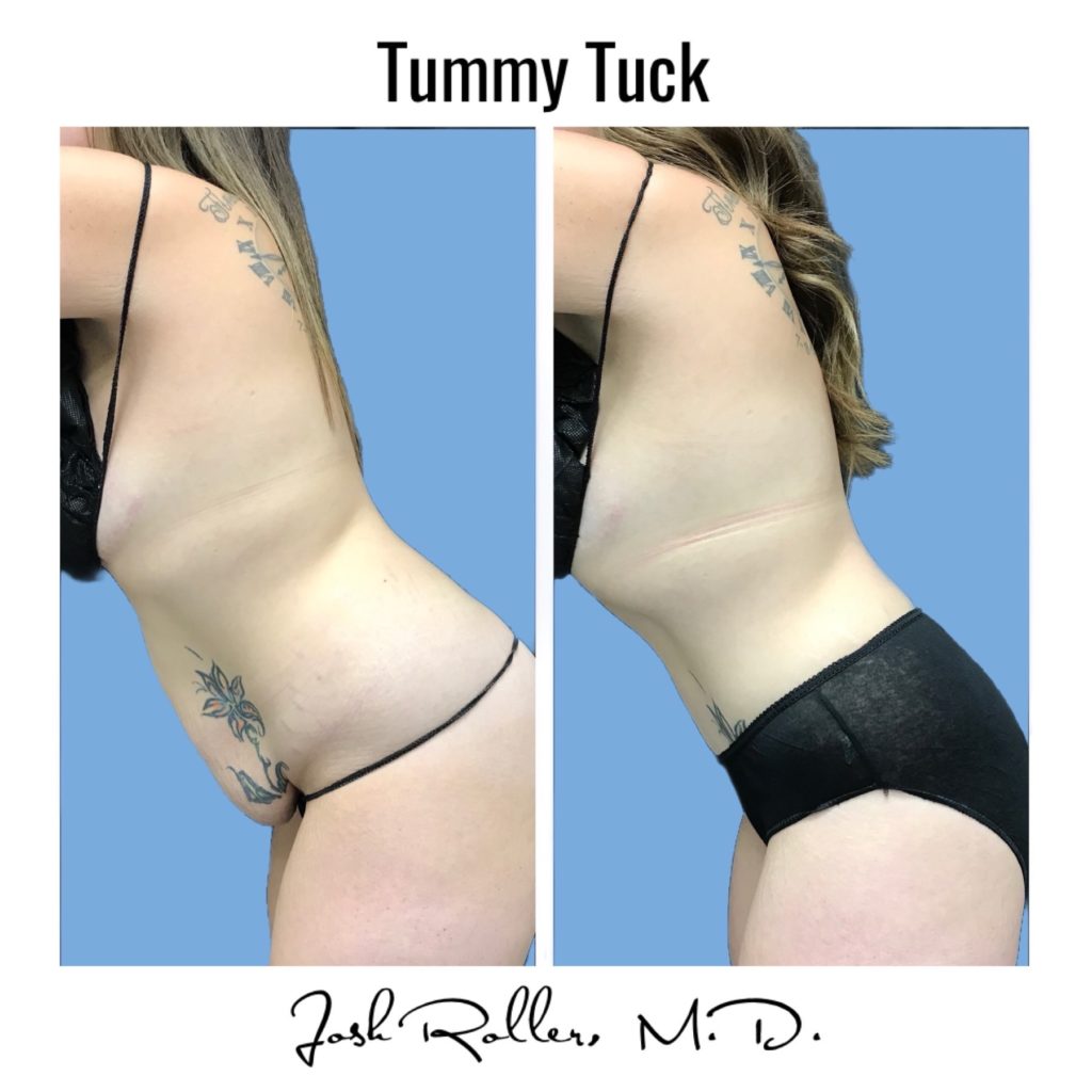 Tummy Tuck and Abdominoplasty Before & After Gallery - Patient 13139 - Image 5