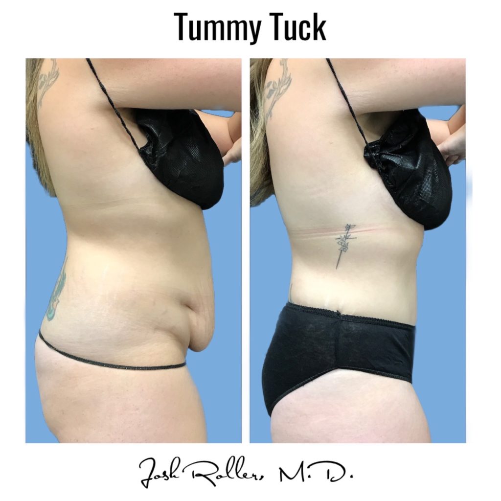 Tummy Tuck and Abdominoplasty Before & After Gallery - Patient 13139 - Image 7