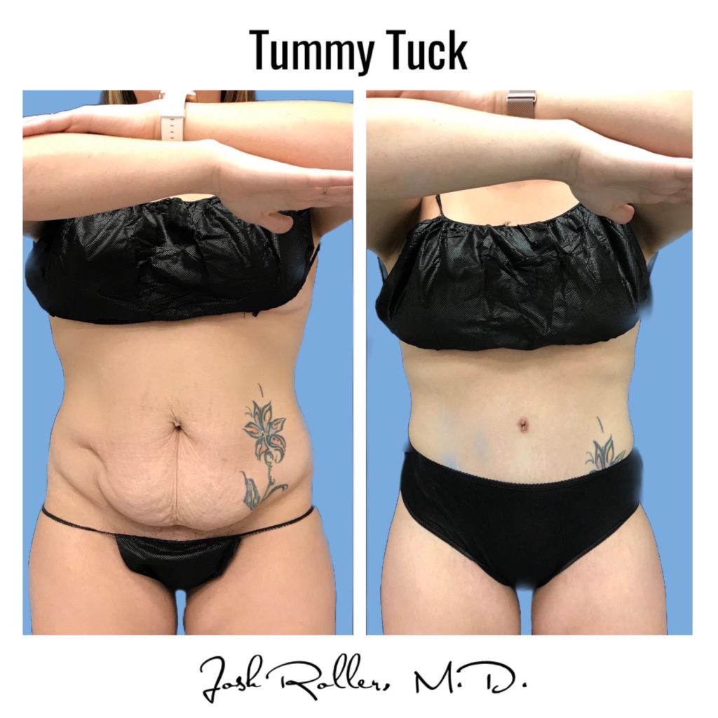 Tummy Tuck and Abdominoplasty Before & After Gallery - Patient 13139 - Image 8