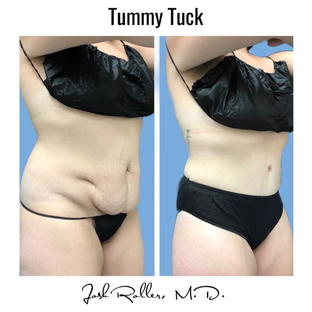 Tummy Tuck and Abdominoplasty Before & After Gallery - Patient 13139 - Image 9