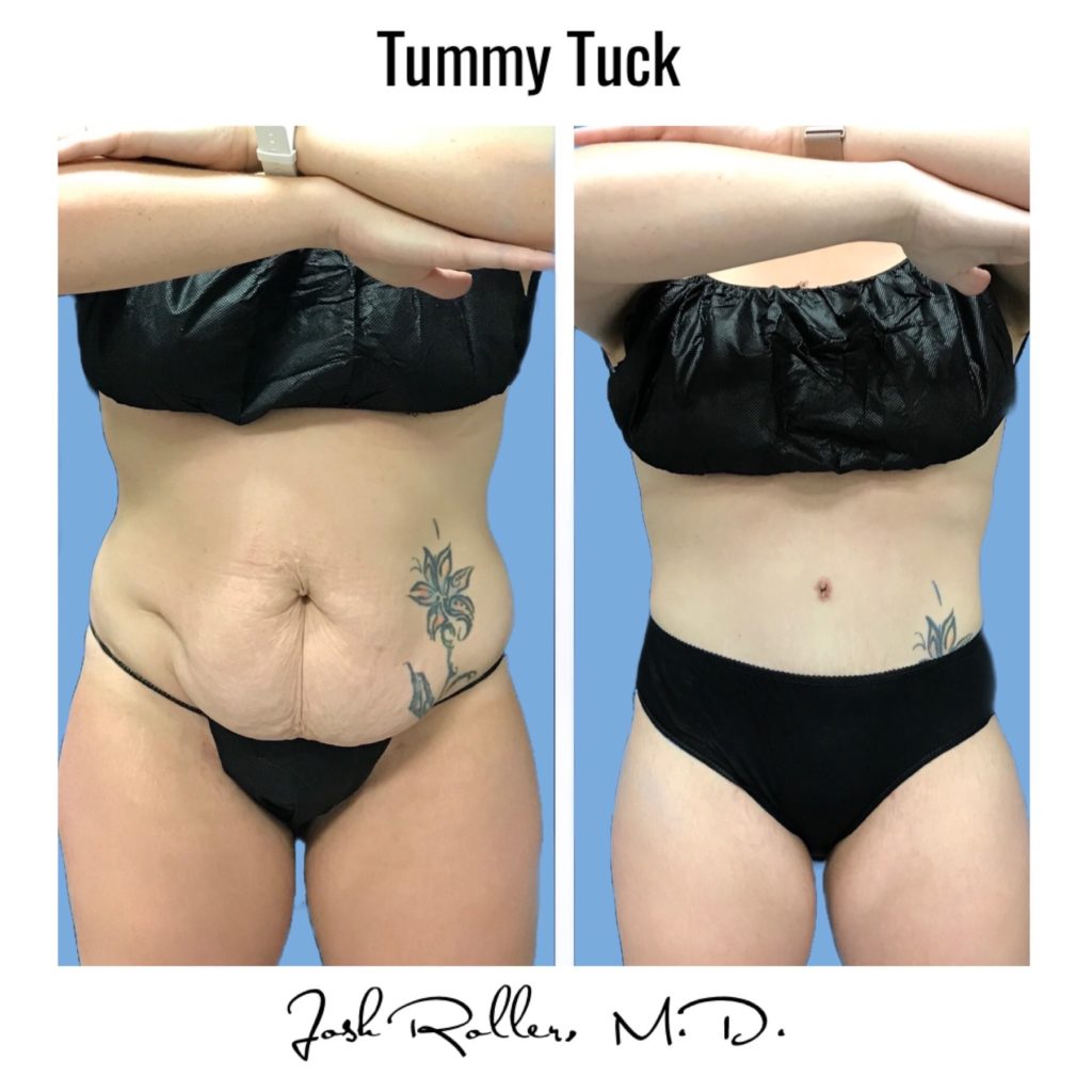 Tummy Tuck and Abdominoplasty Before & After Gallery - Patient 13139 - Image 10