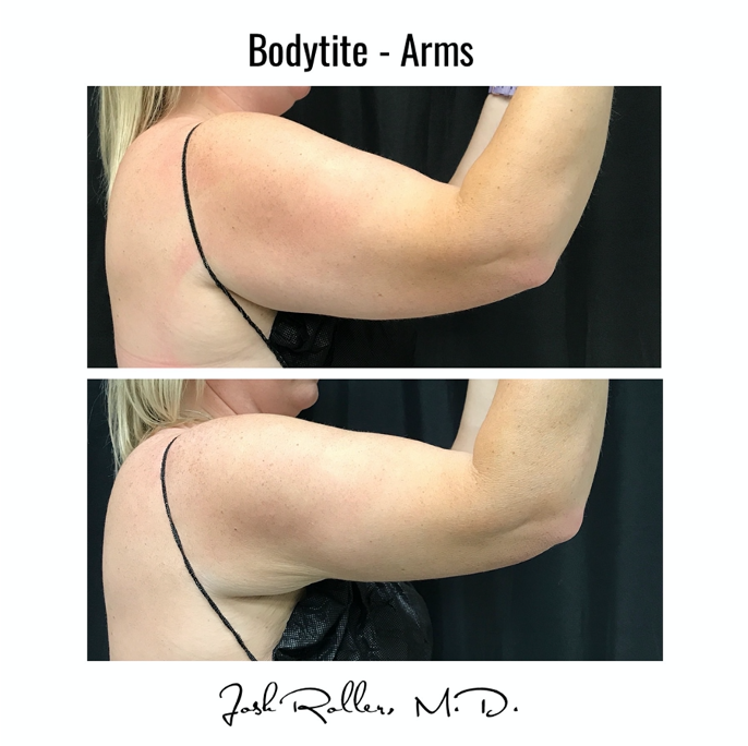 BodyTite Before & After Gallery - Patient 12802 - Image 1
