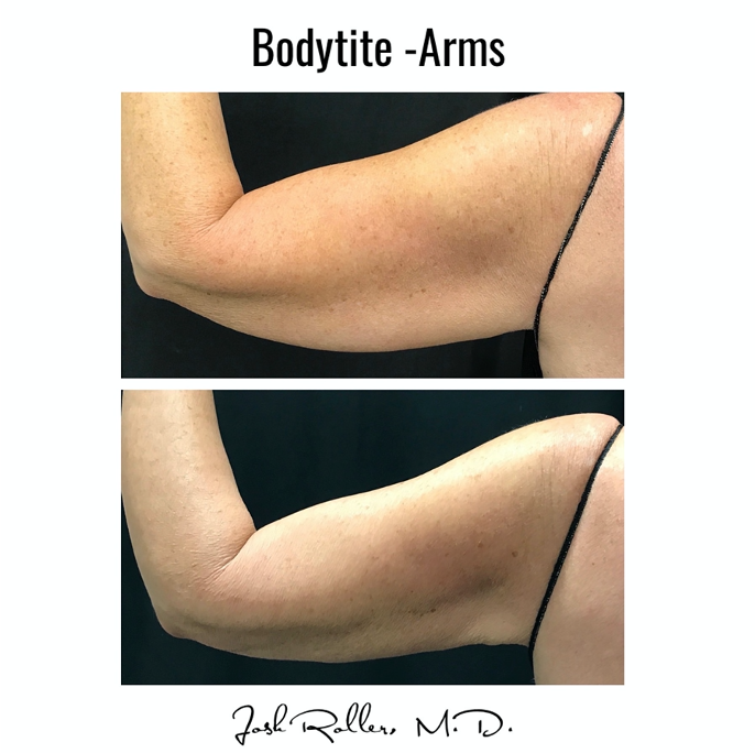 BodyTite Before & After Gallery - Patient 12797 - Image 2