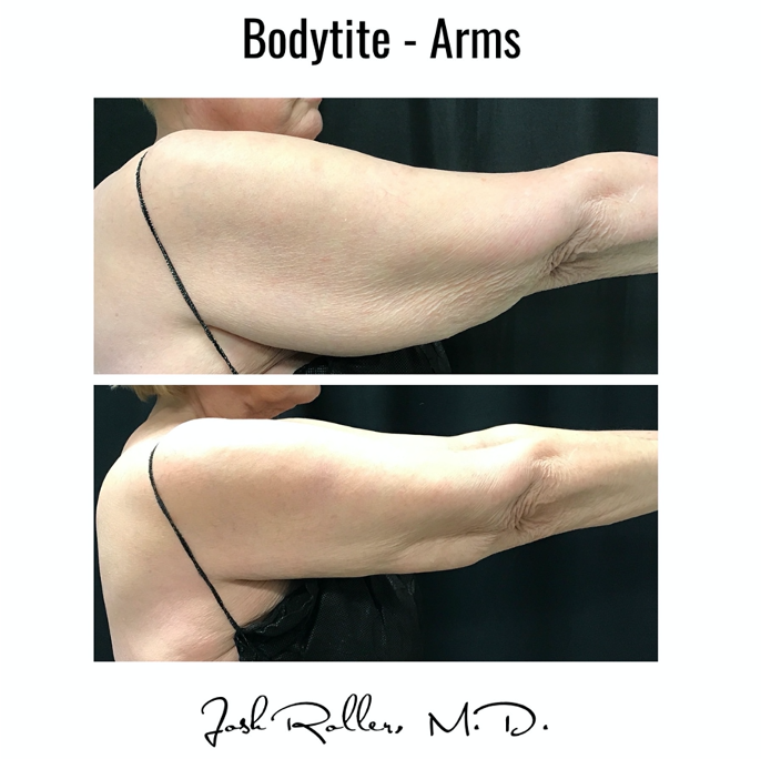 BodyTite Before & After Gallery - Patient 12795 - Image 1