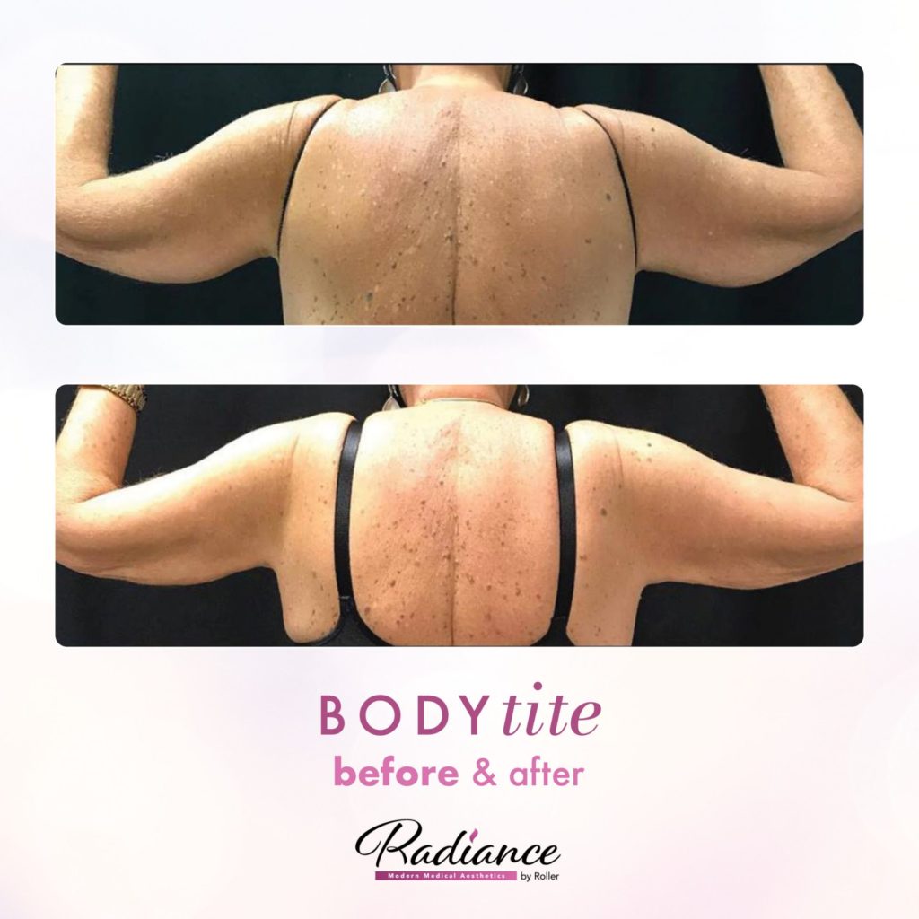 BodyTite Before & After Gallery - Patient 12777 - Image 1