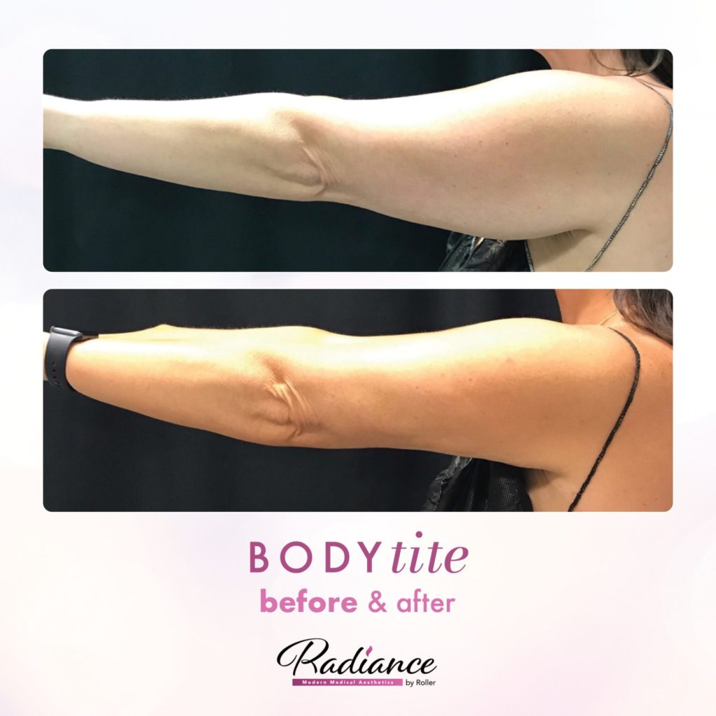 BodyTite Before & After Gallery - Patient 12774 - Image 2
