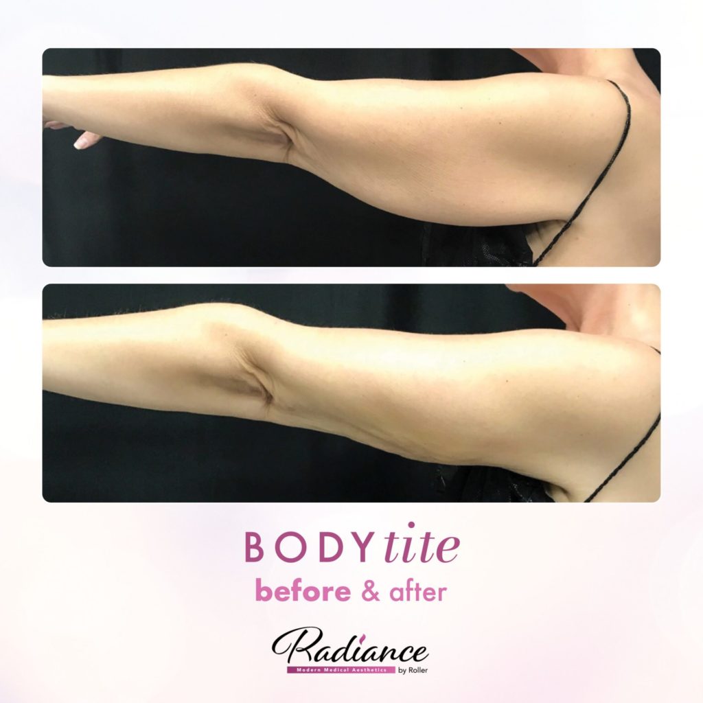 BodyTite Before & After Gallery - Patient 12769 - Image 1