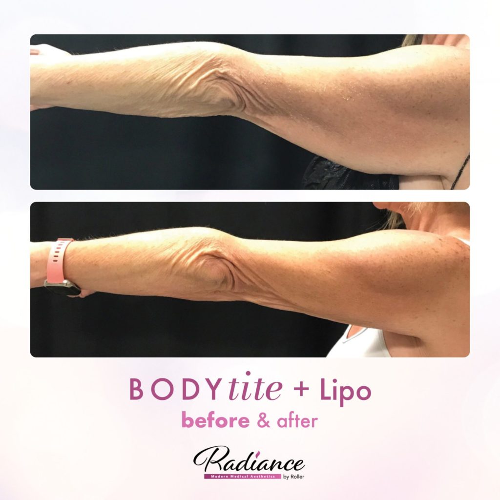 BodyTite Before & After Gallery - Patient 12767 - Image 1