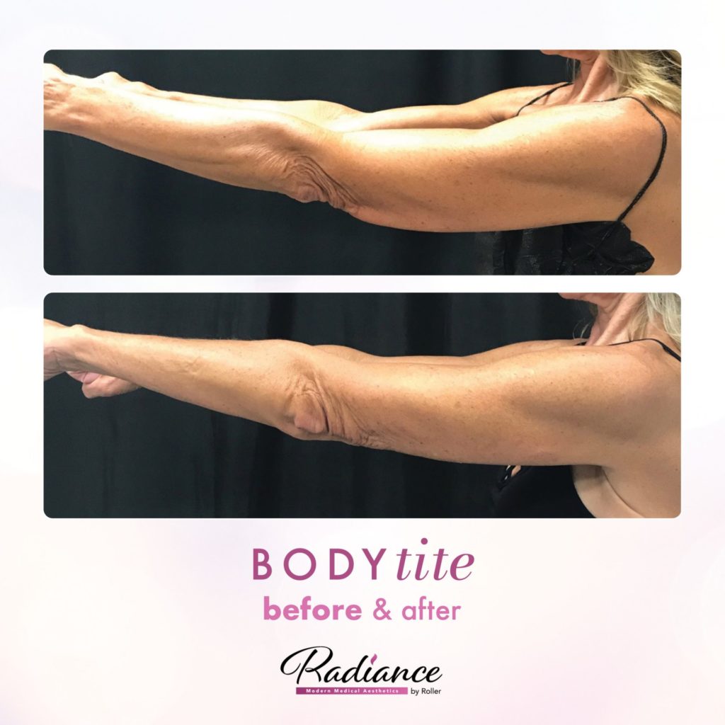 BodyTite Before & After Gallery - Patient 12764 - Image 1