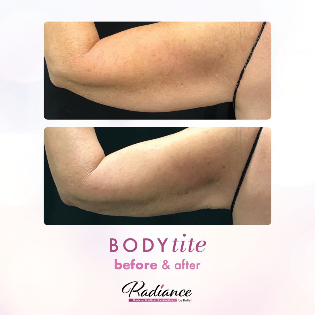 BodyTite Before & After Gallery - Patient 12759 - Image 1