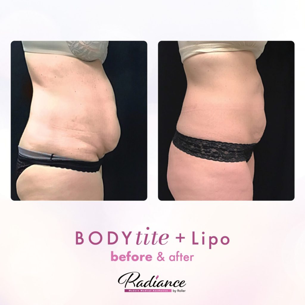 BodyTite Before & After Gallery - Patient 12751 - Image 1