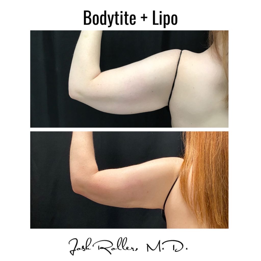 BodyTite Before & After Gallery - Patient 12740 - Image 1