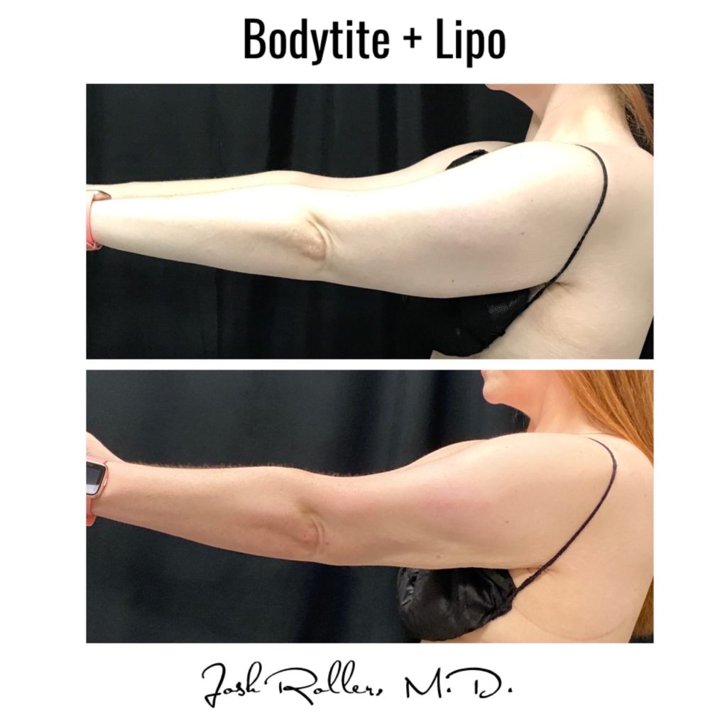 BodyTite Before & After Gallery - Patient 12740 - Image 4