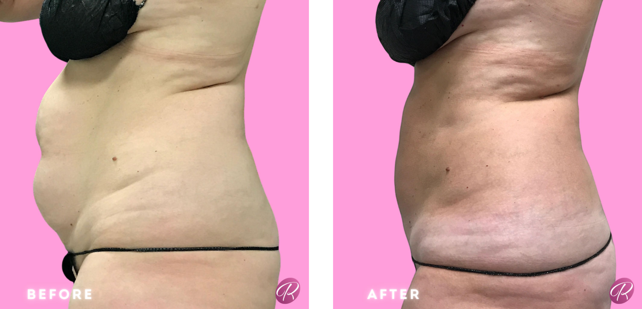 BodyTite Before & After Gallery - Patient 12830 - Image 1