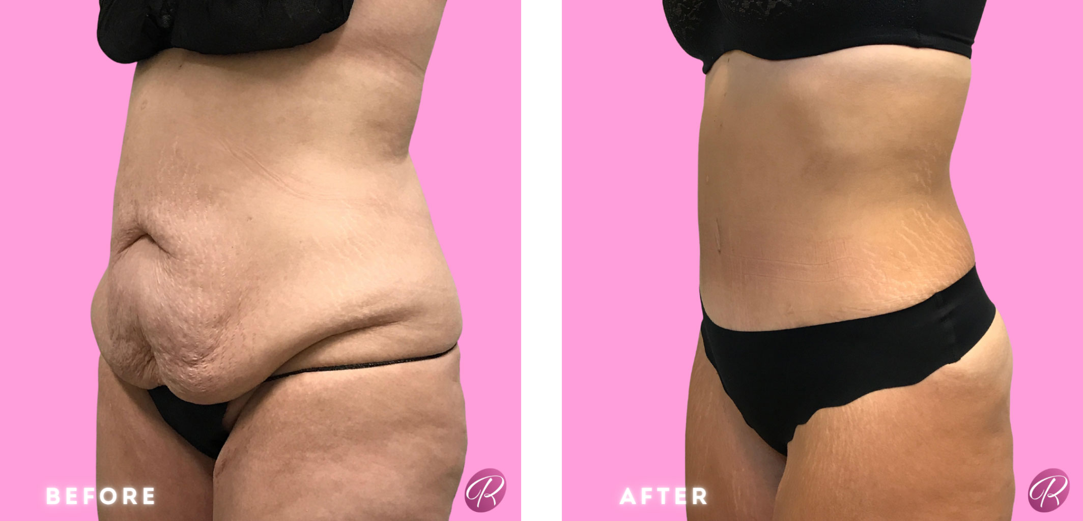 Tummy Tuck and Abdominoplasty Before & After Gallery - Patient 13159 - Image 2
