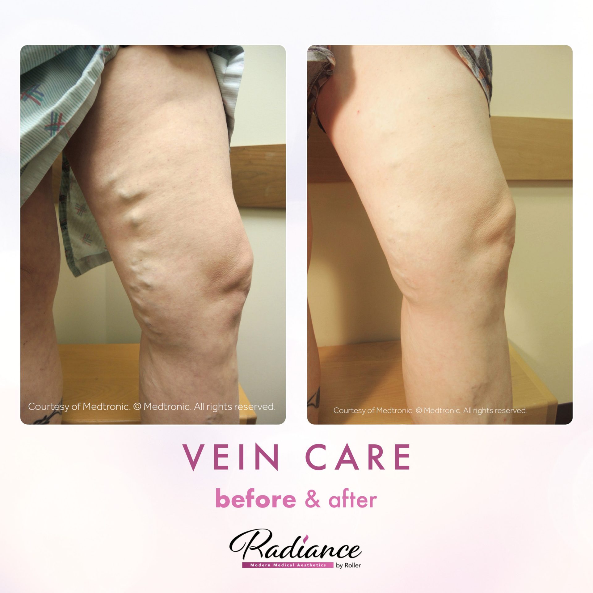 Veins Before & After Gallery - Patient 13187 - Image 1
