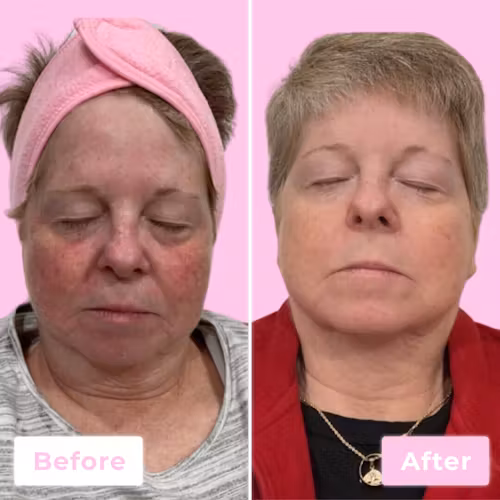 Morpheus8 Before & After Gallery - Patient 13102 - Image 1