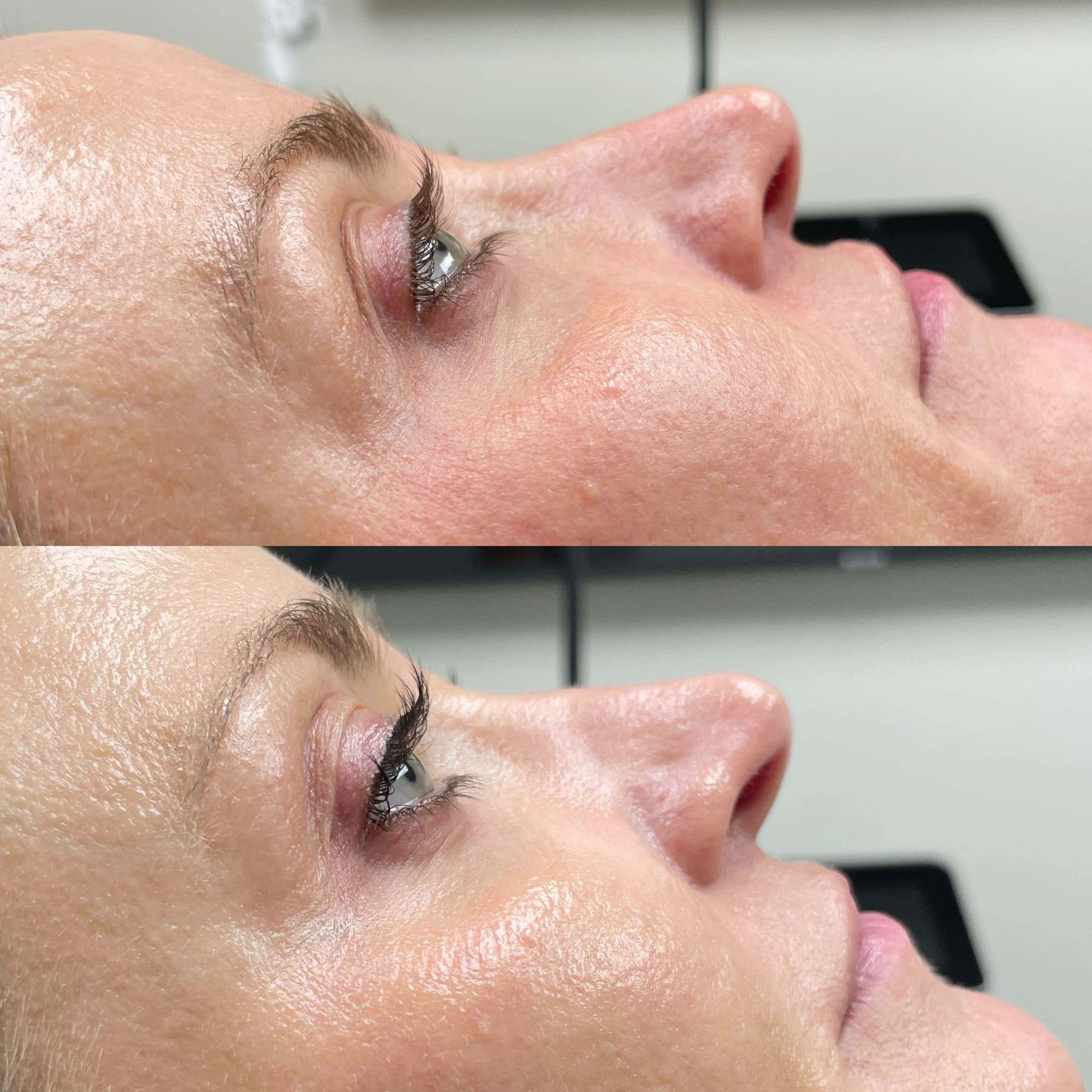 Lash Lift & Tint Before & After Gallery - Patient 13183 - Image 1