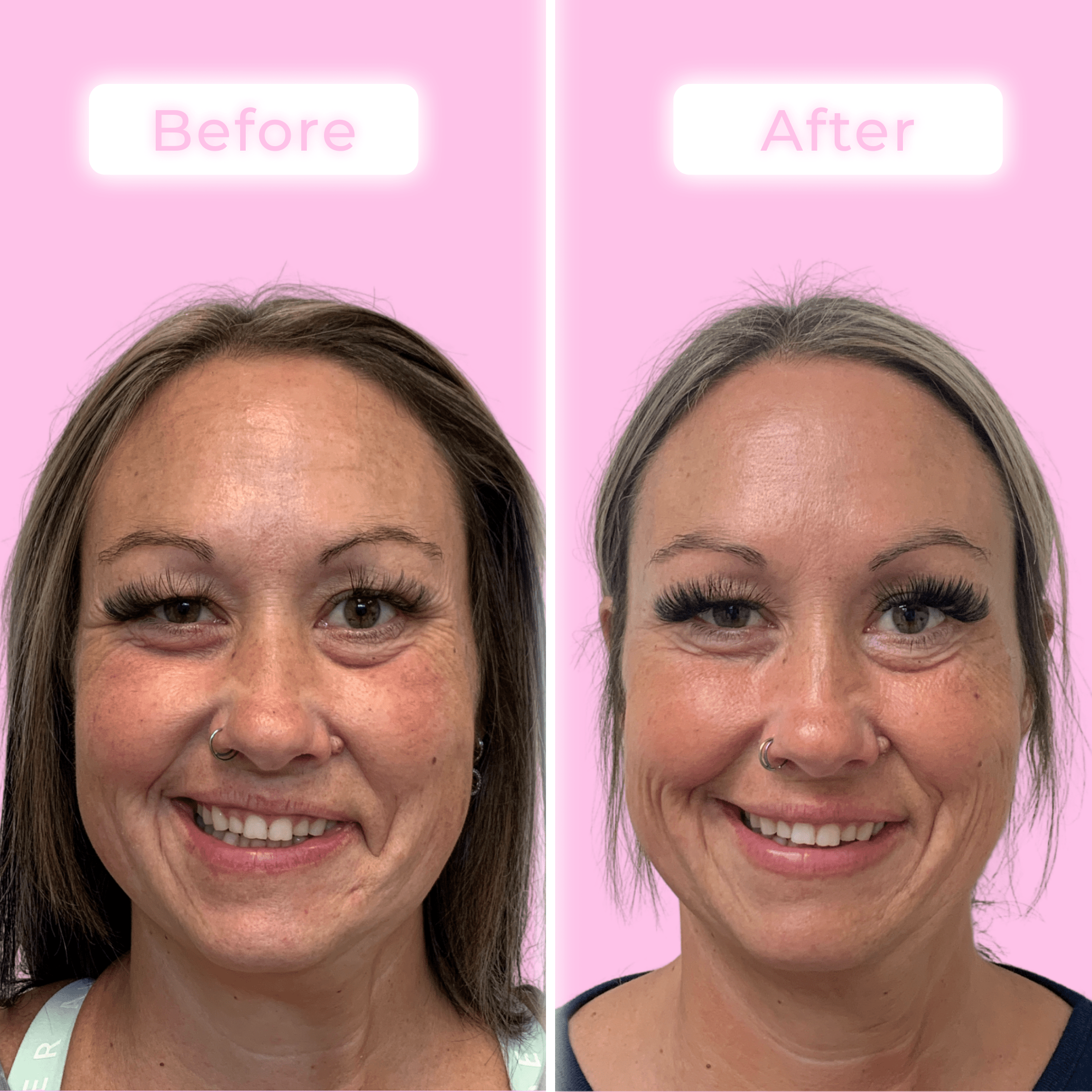 Fillers Before & After Gallery - Patient 12518 - Image 1
