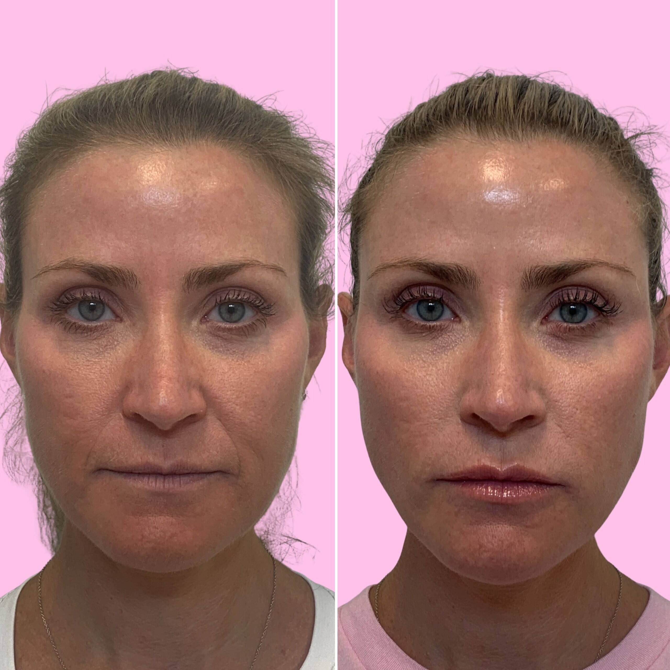 Fillers Before & After Gallery - Patient 12515 - Image 1