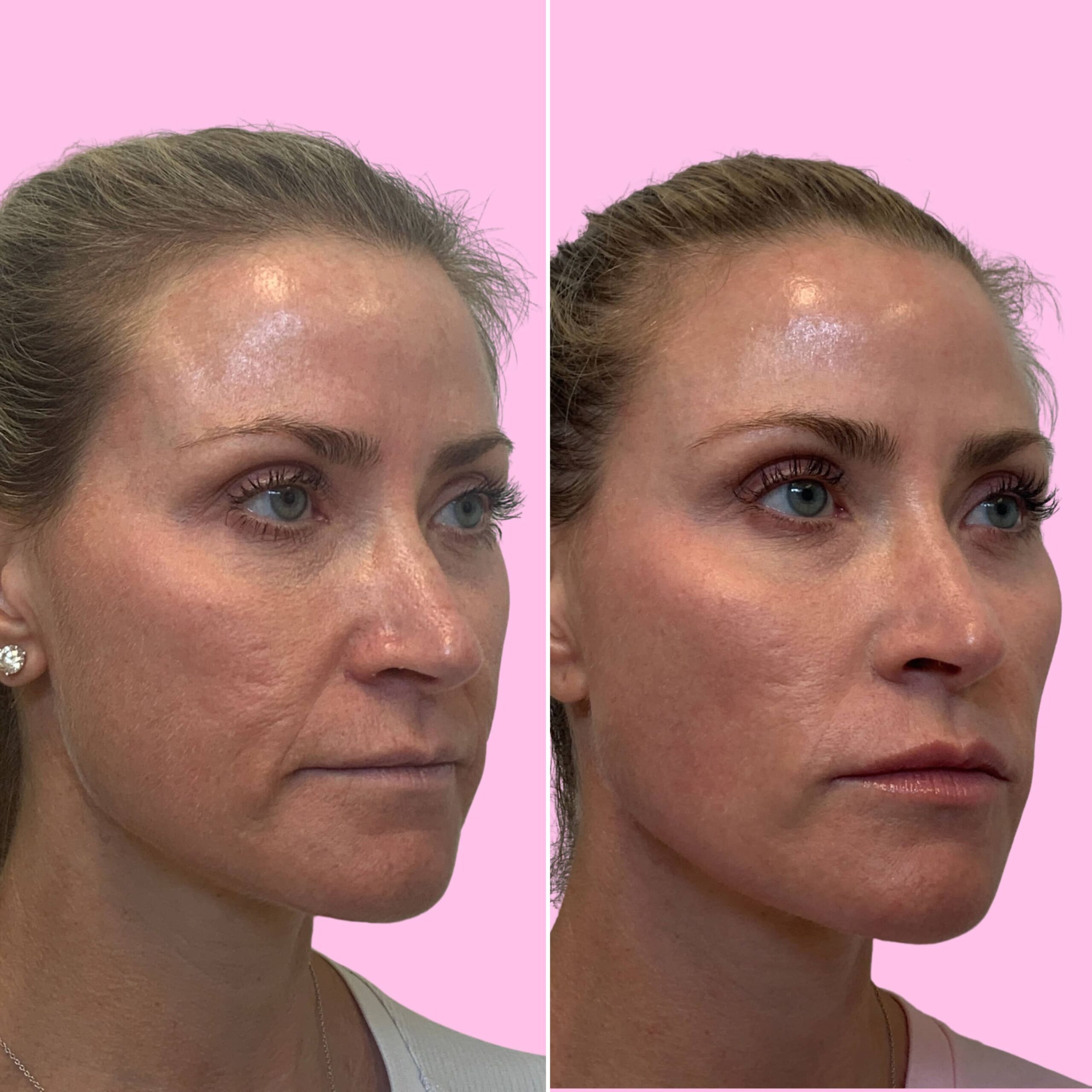 Fillers Before & After Gallery - Patient 12515 - Image 2