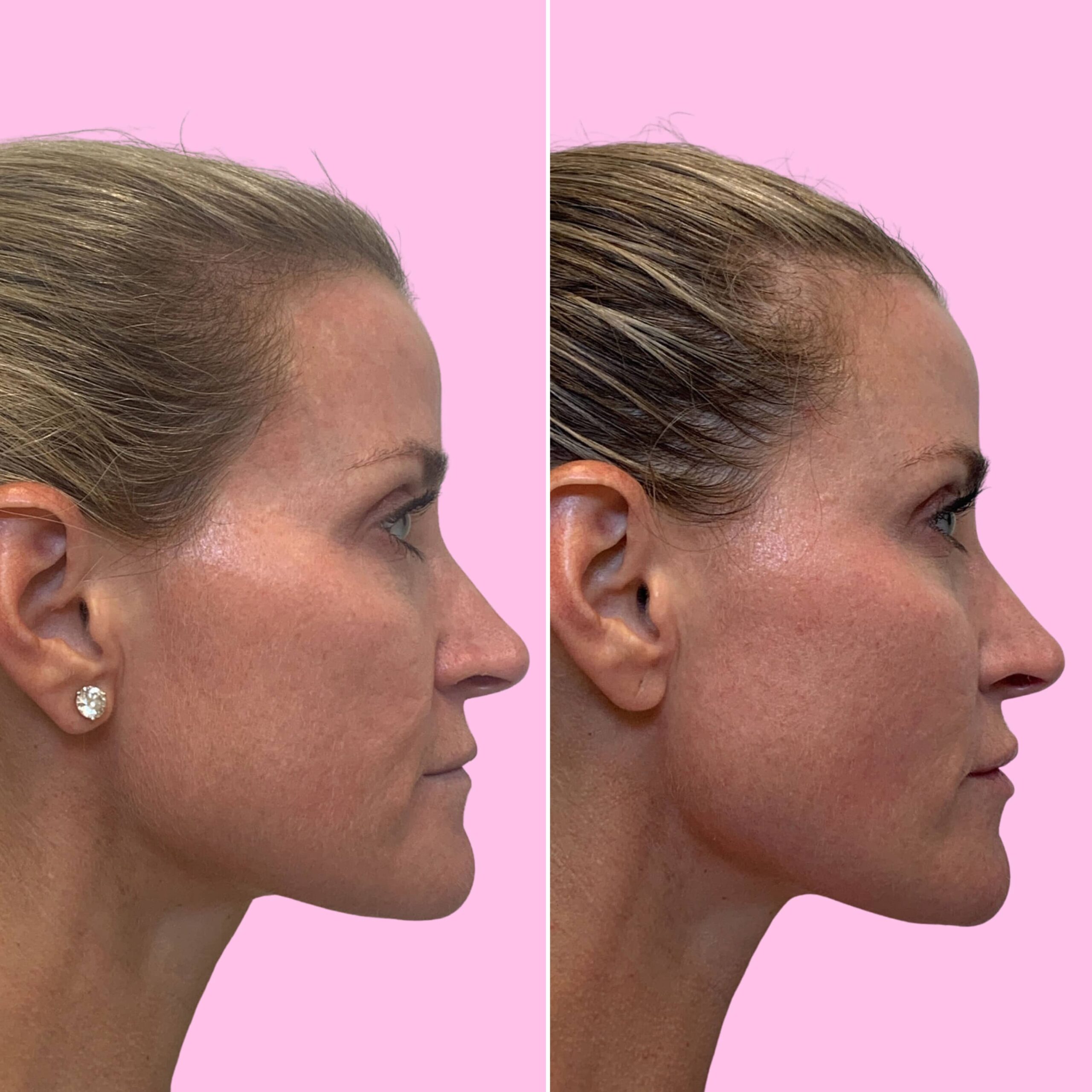 Fillers Before & After Gallery - Patient 12515 - Image 3
