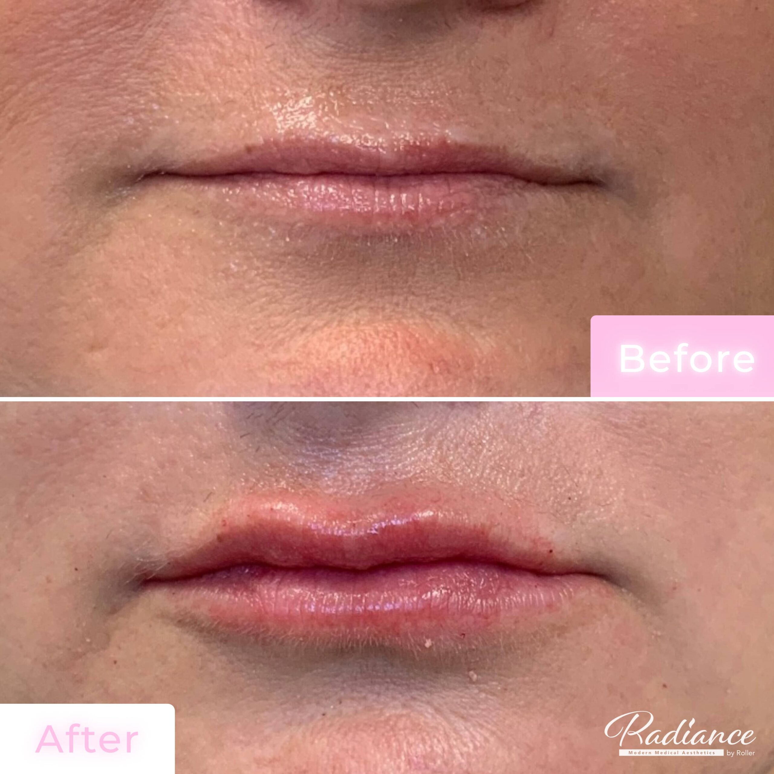 Fillers Before & After Gallery - Patient 12487 - Image 1