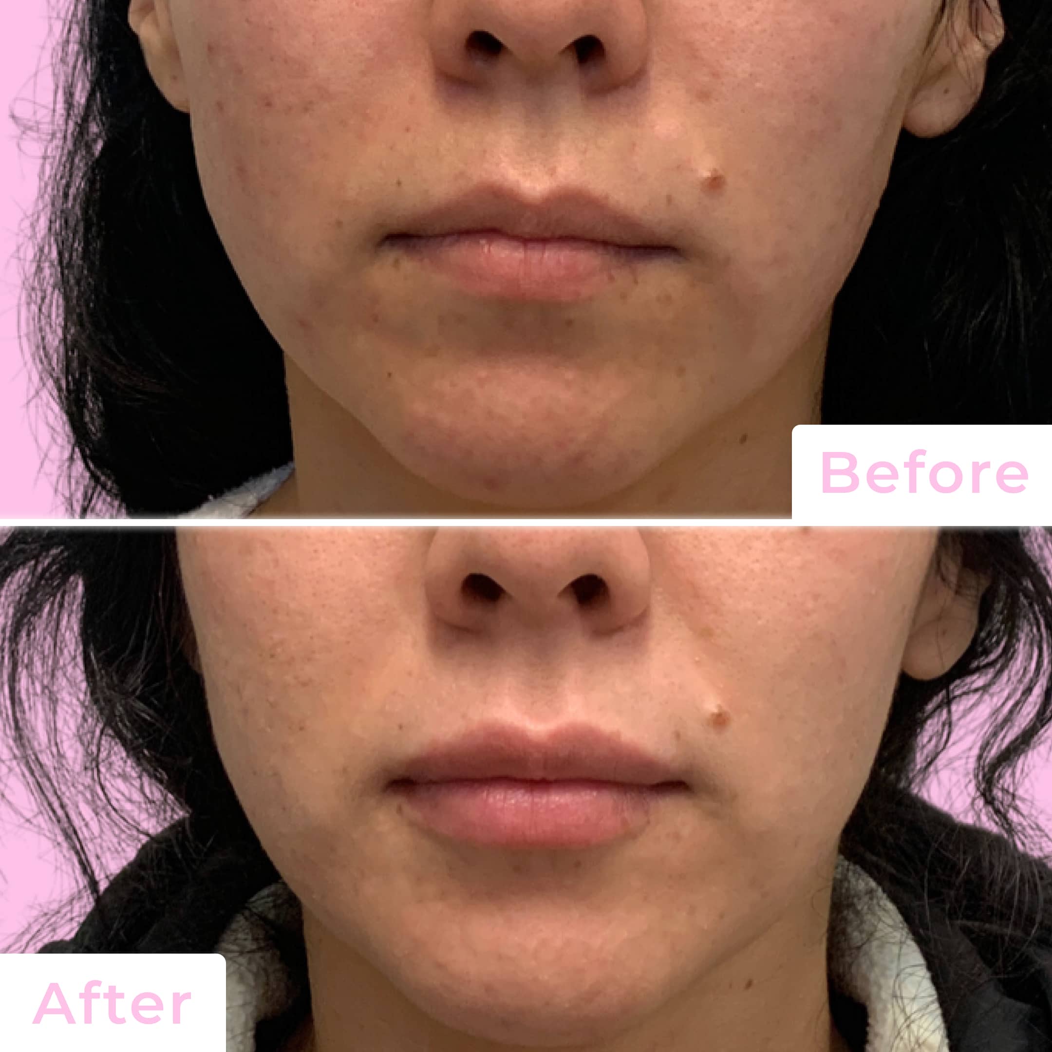 Fillers Before & After Gallery - Patient 12481 - Image 1