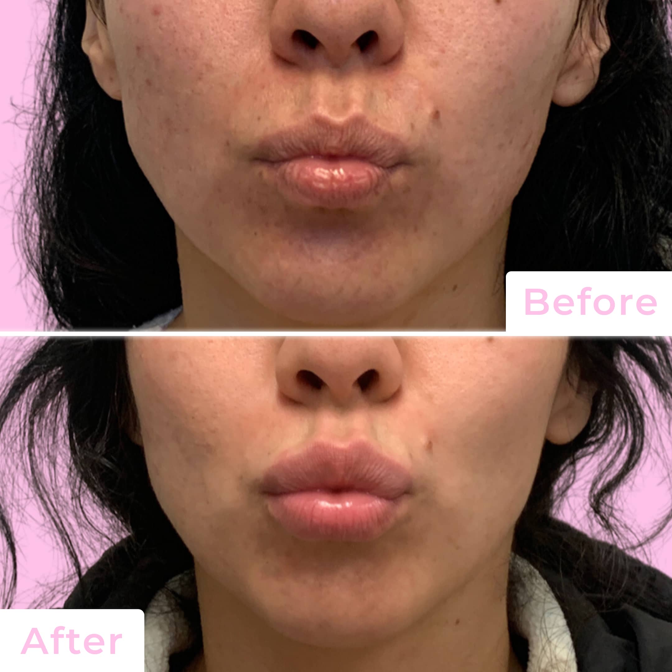 Fillers Before & After Gallery - Patient 12481 - Image 2
