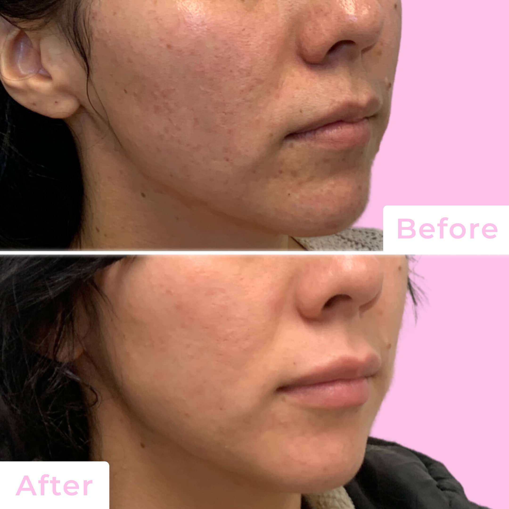Fillers Before & After Gallery - Patient 12481 - Image 4