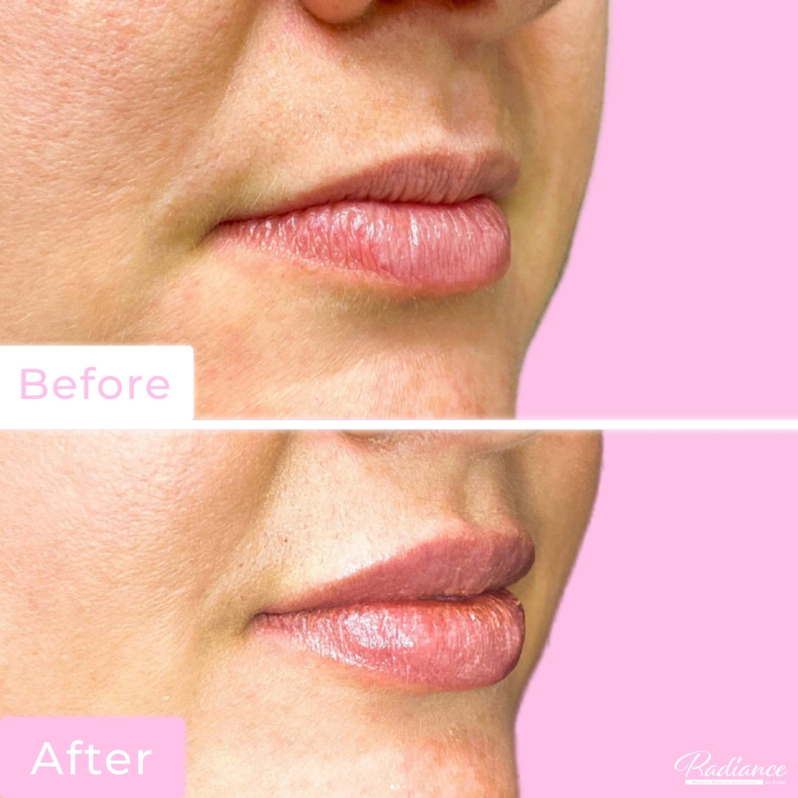 Fillers Before & After Gallery - Patient 12477 - Image 1