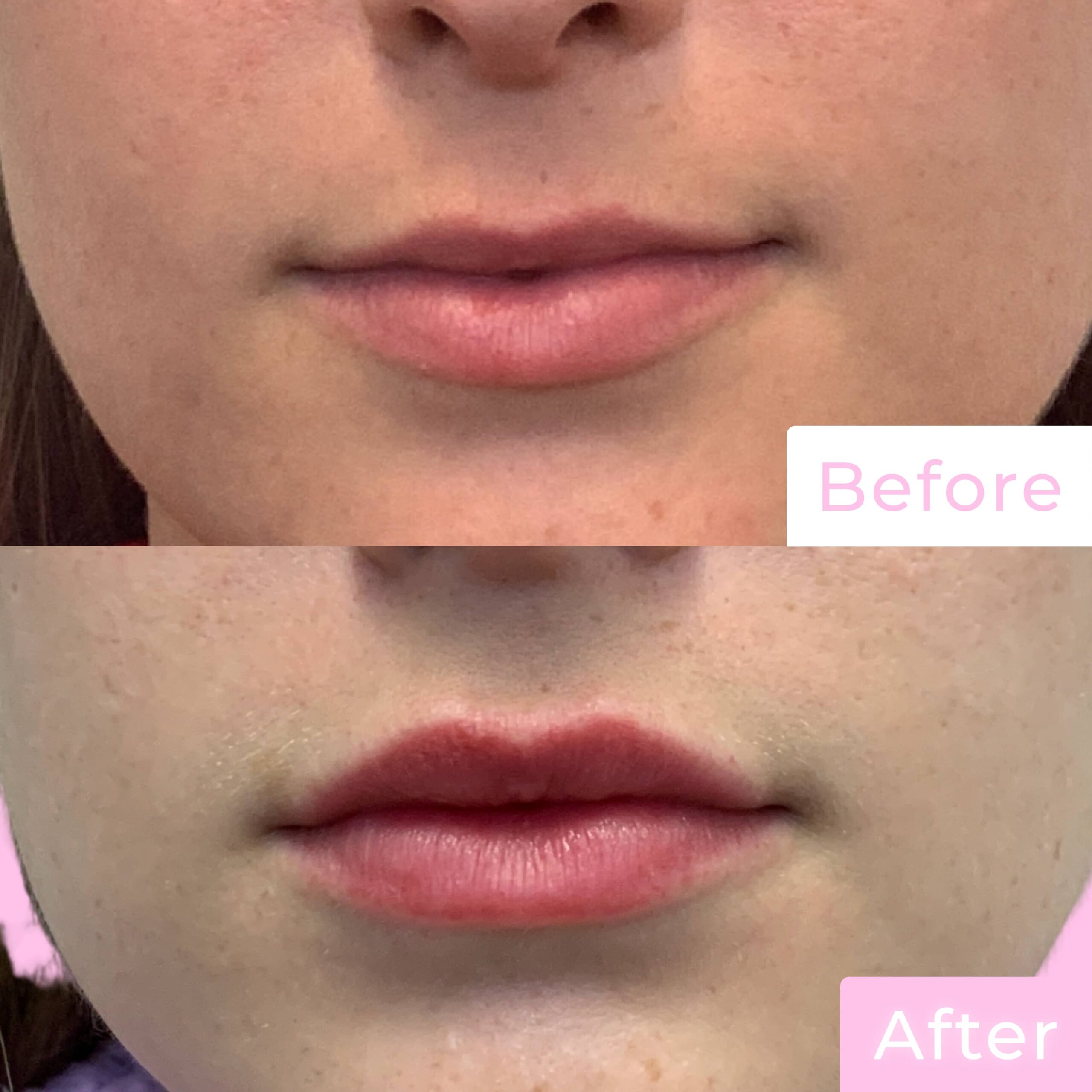 Fillers Before & After Gallery - Patient 12510 - Image 1