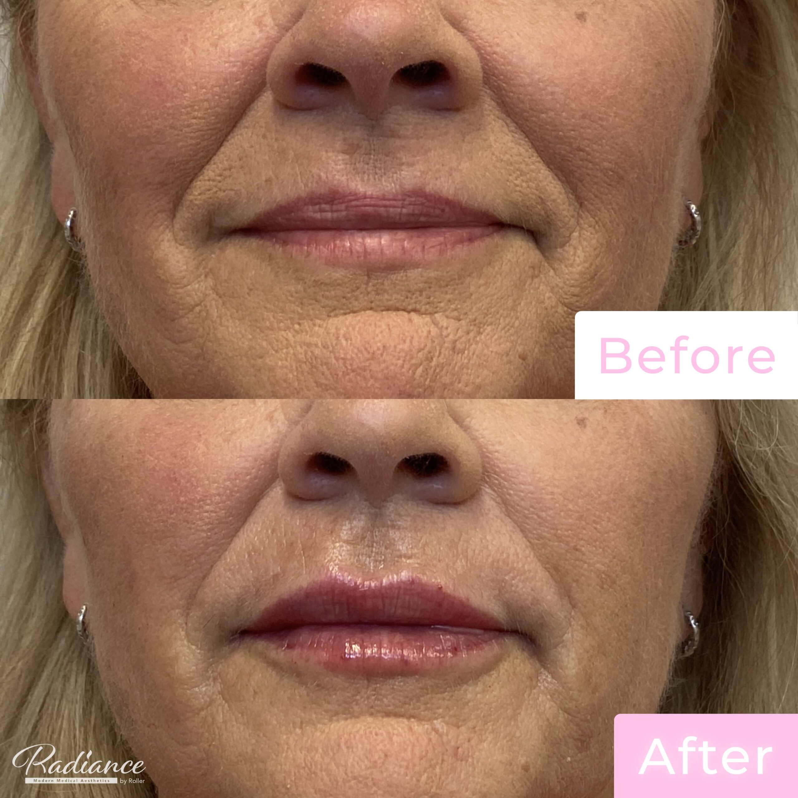 Fillers Before & After Gallery - Patient 12508 - Image 1
